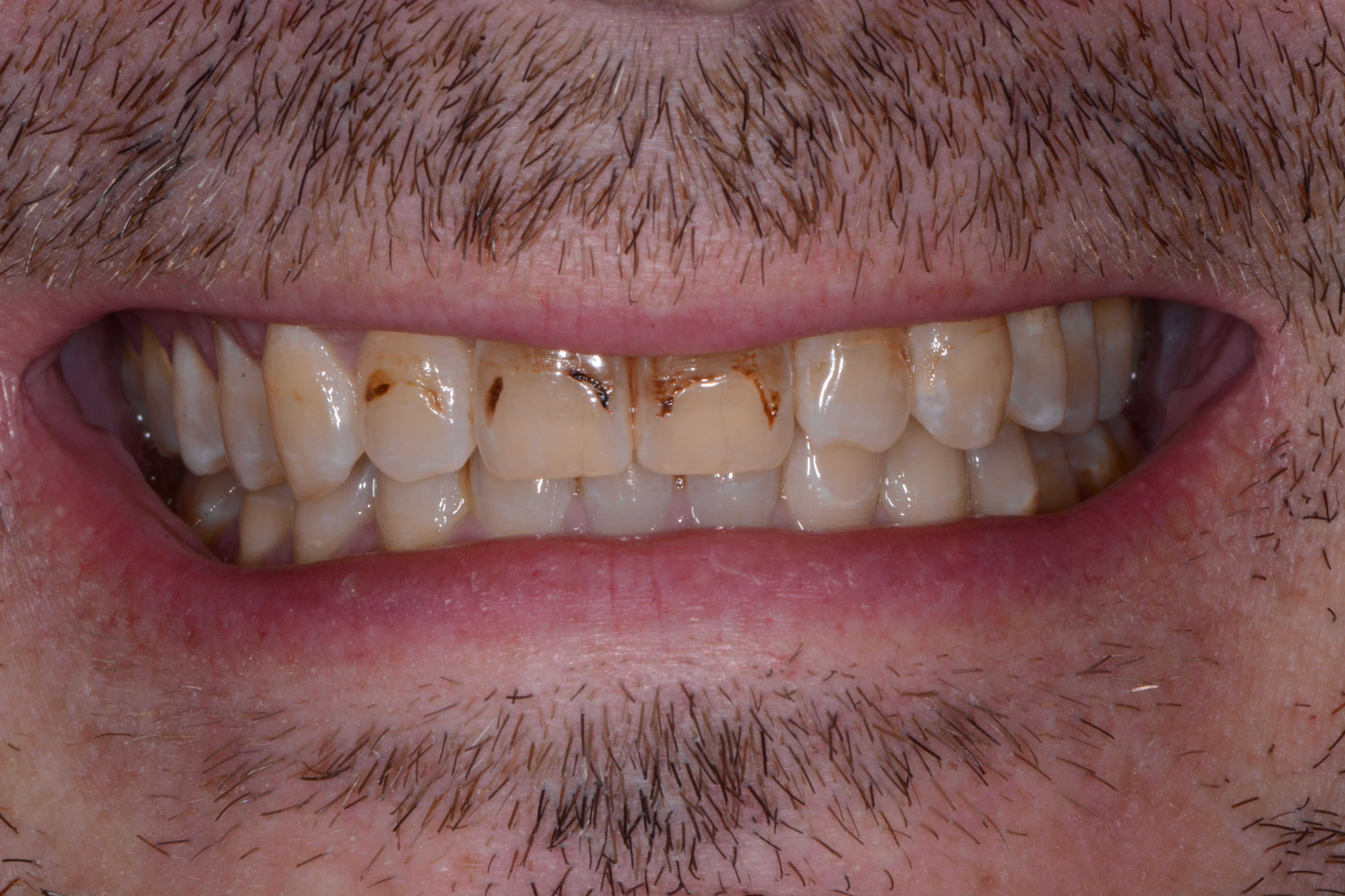 I'm all smiles now. Before