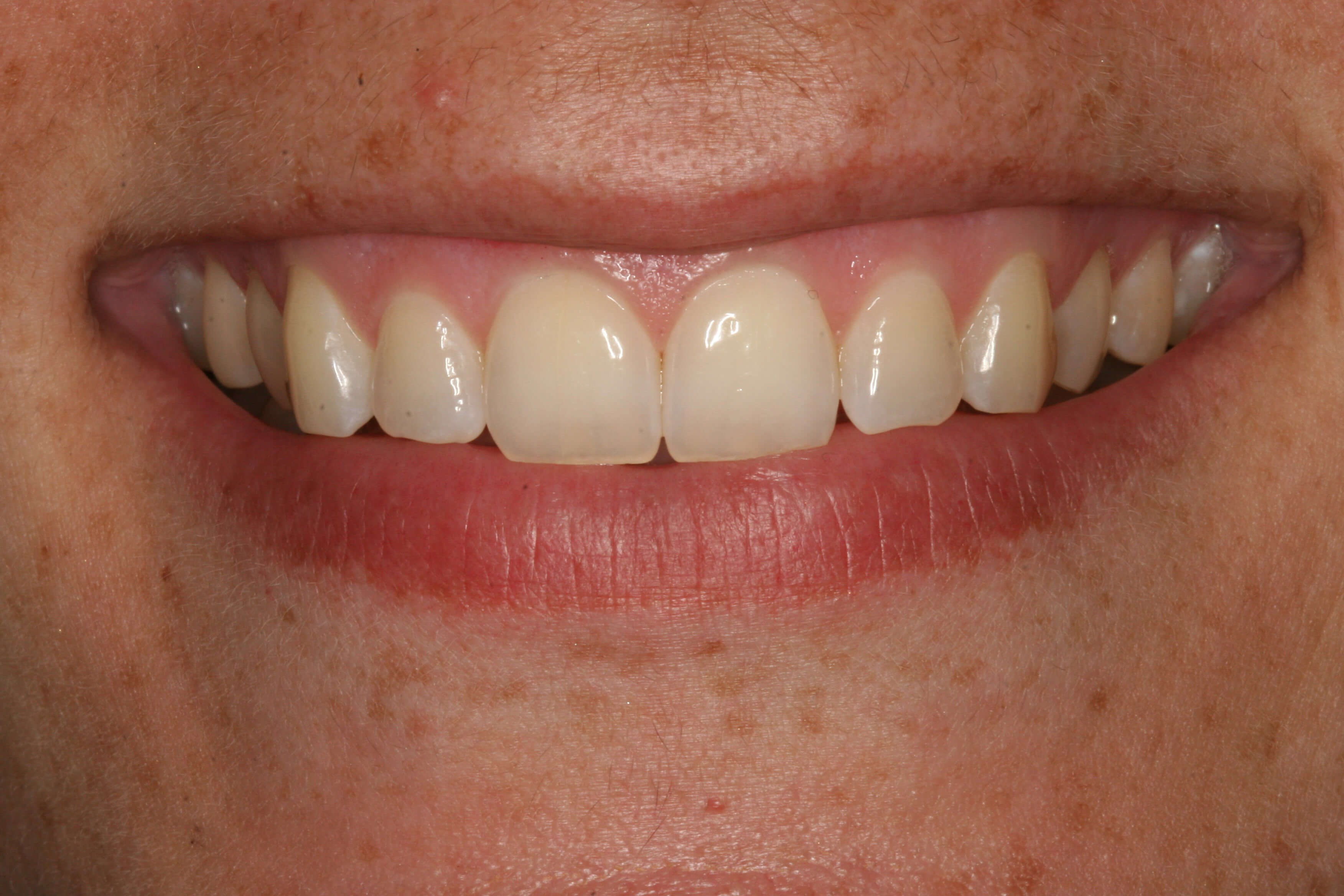 Uses Her Smile Daily! Before