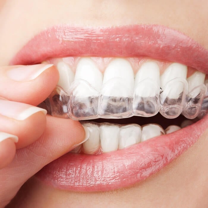 Orthodontics & Aligners Image