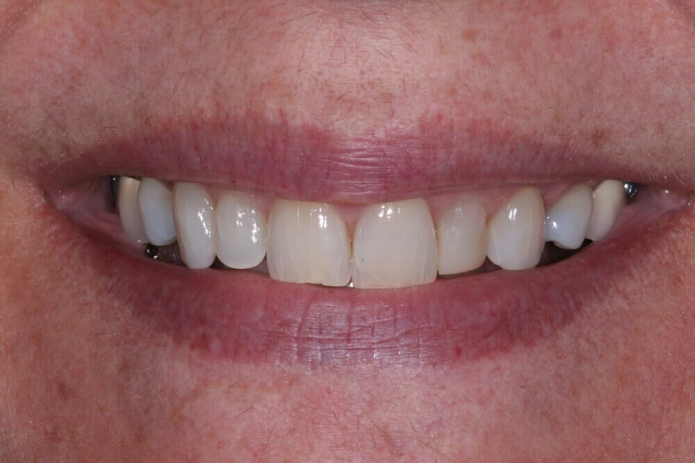 A Veneer is a Veneer, Right? What to Know Before Getting Dental Veneers.